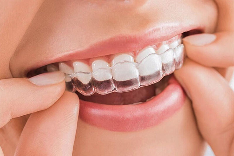 Nên niềng răng hay bọc răng sứ? So sánh hai phương pháp
